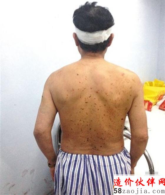 一名礦工因爆炸沖擊波摔倒在巷道側(cè)壁上,背部多處受傷,頭部縫了七針